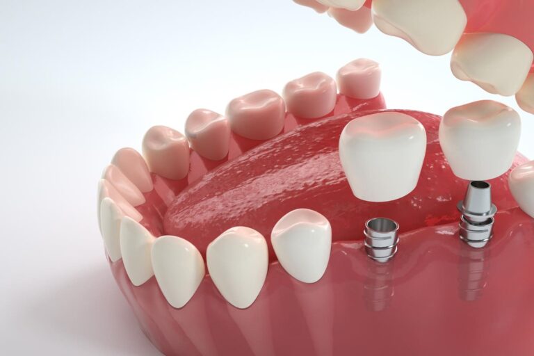 cómo se pone un implante dental