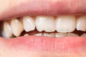 Qué es una reconstrucción dental