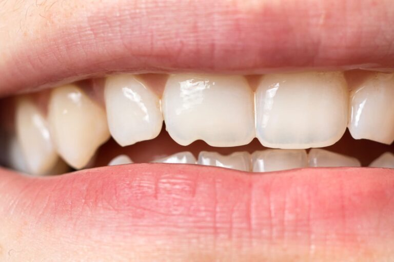 Qué es una reconstrucción dental