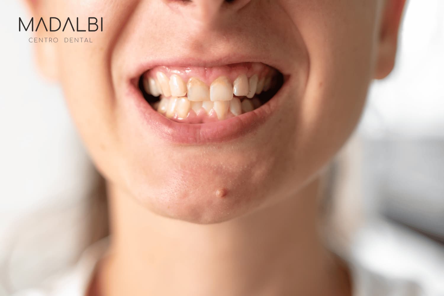 Dientes apiñados