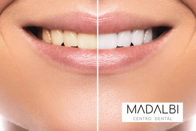 Blanqueamiento dental en Ciudad Lineal