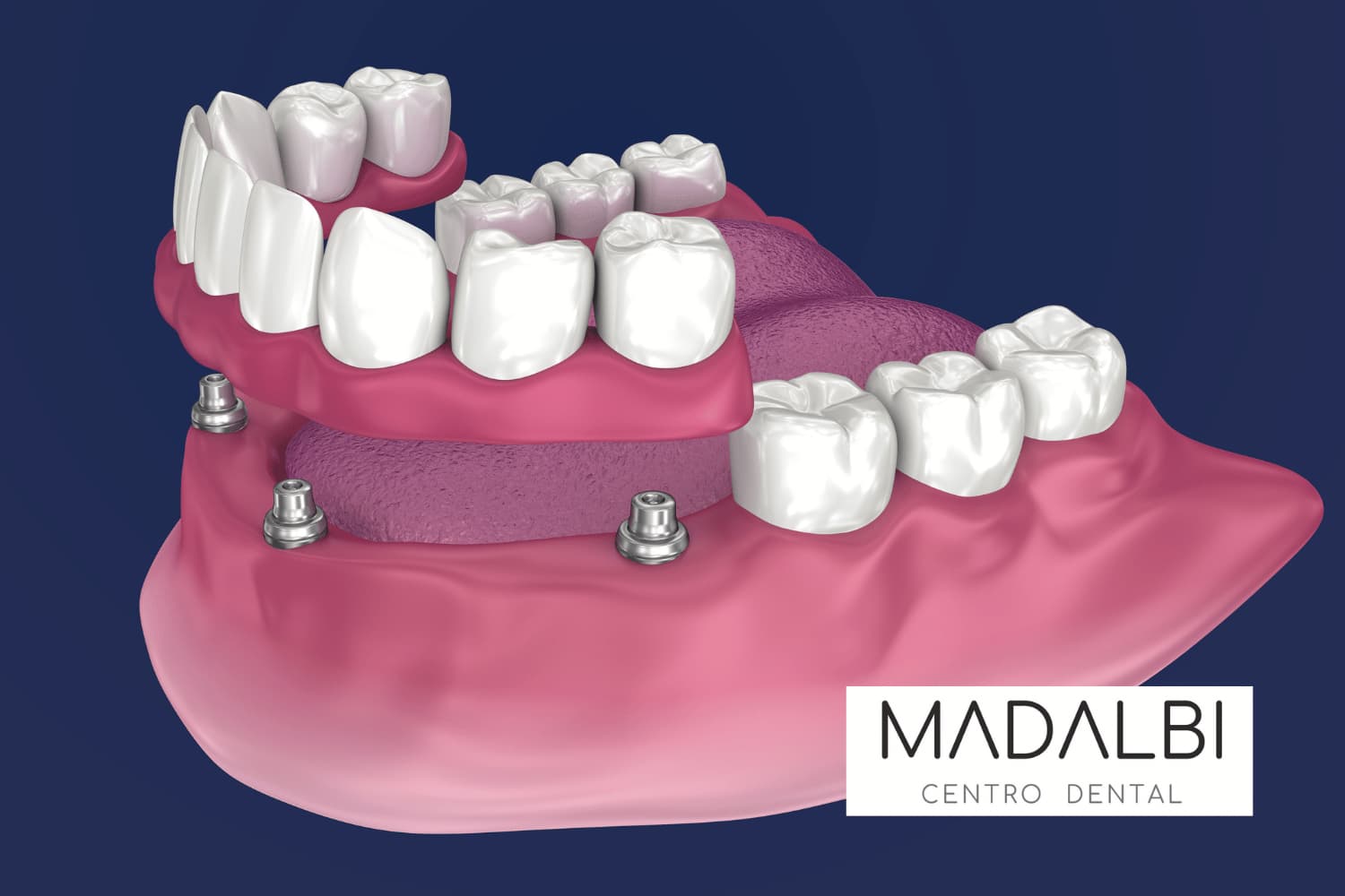 Dientes fijos en un día