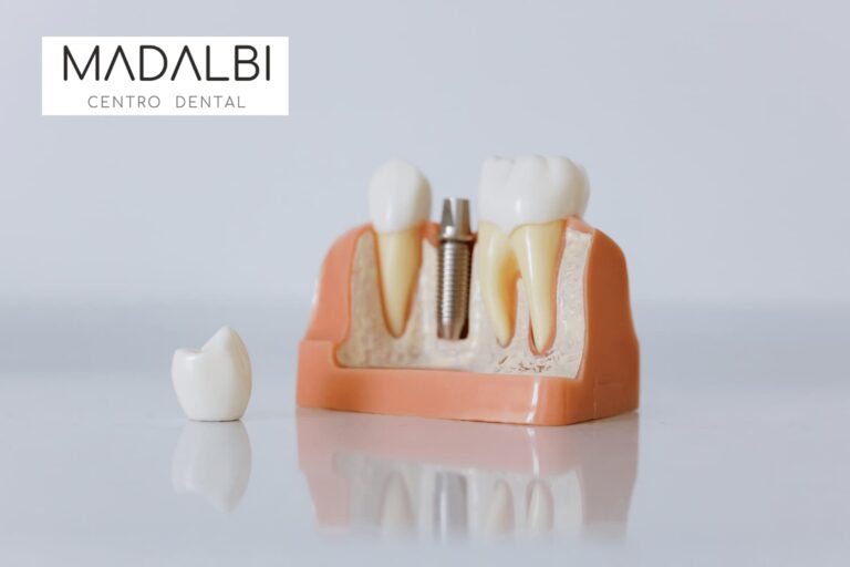 Implantes dentales en Ciudad Lineal